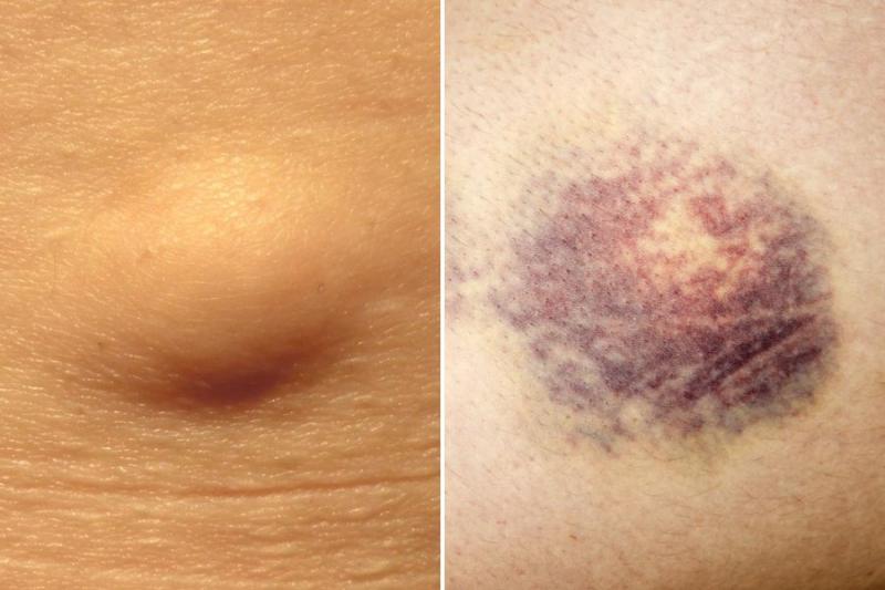 Difference Between Lipoma and Hematoma