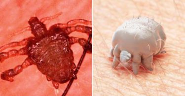 Difference Between Pubic Lice and Scabies