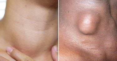 Difference Between Goitre and Thyroid Nodules