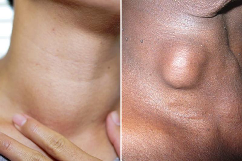 Difference Between Goitre and Thyroid Nodules